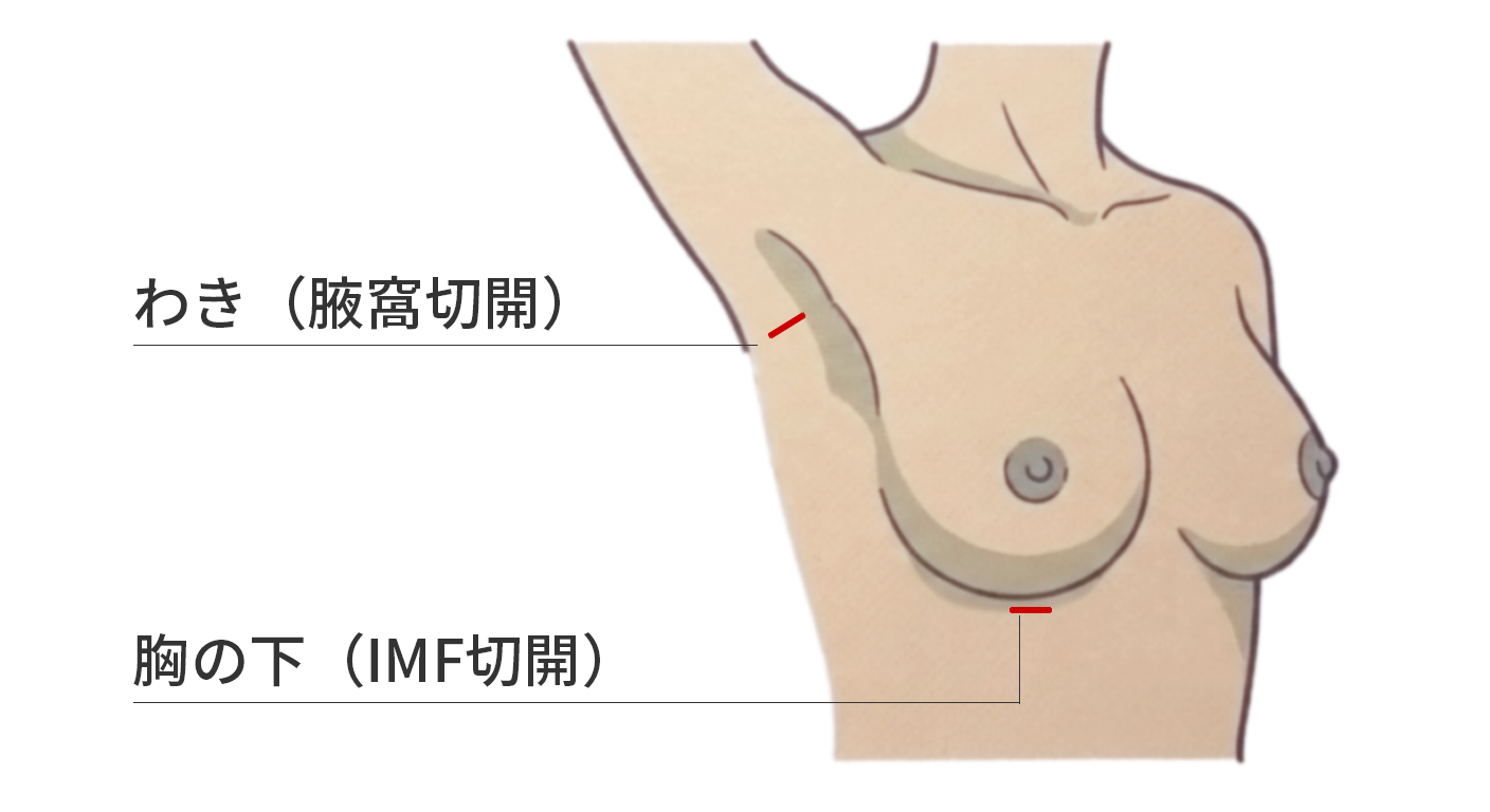 シリコン豊胸 切開部位