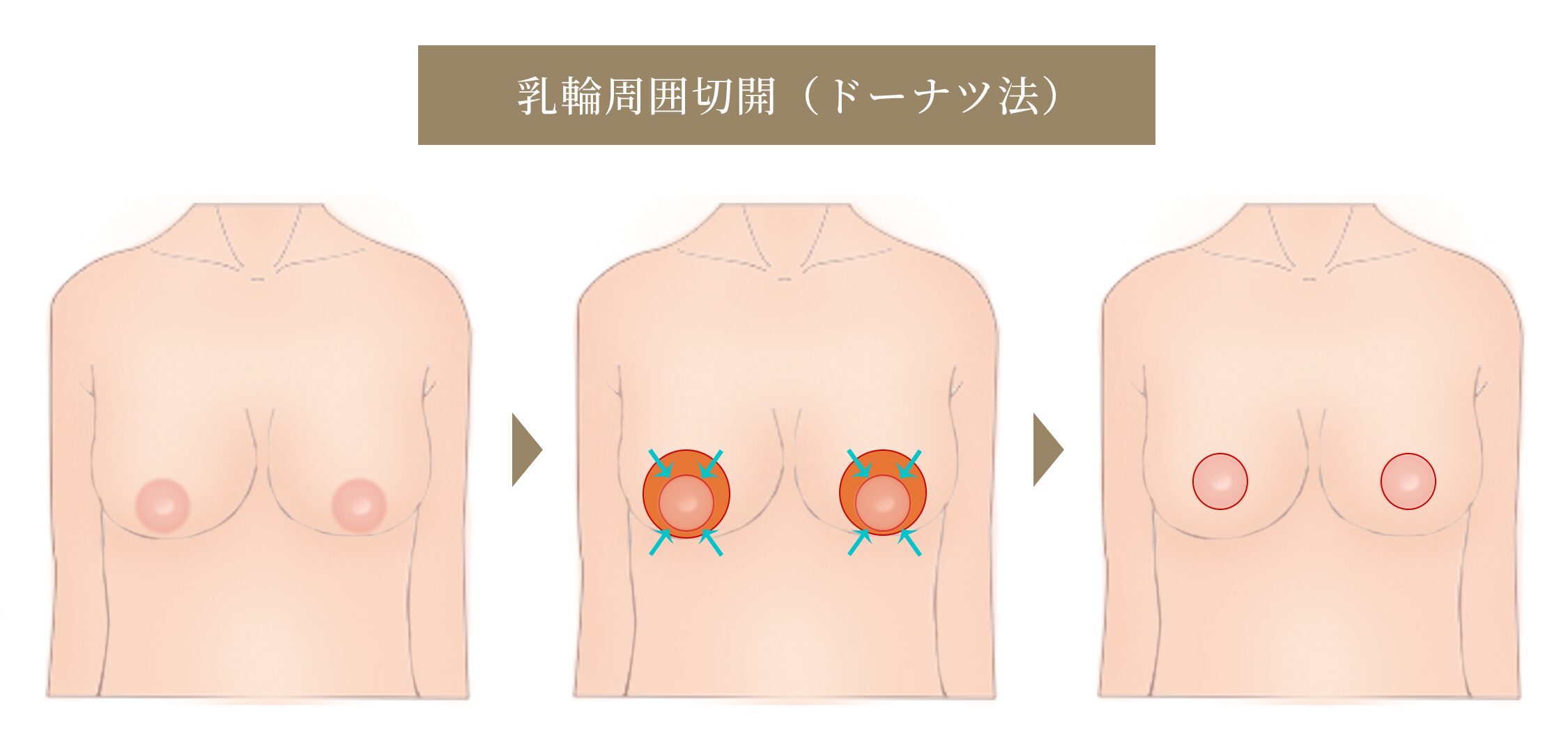 乳輪周囲切開