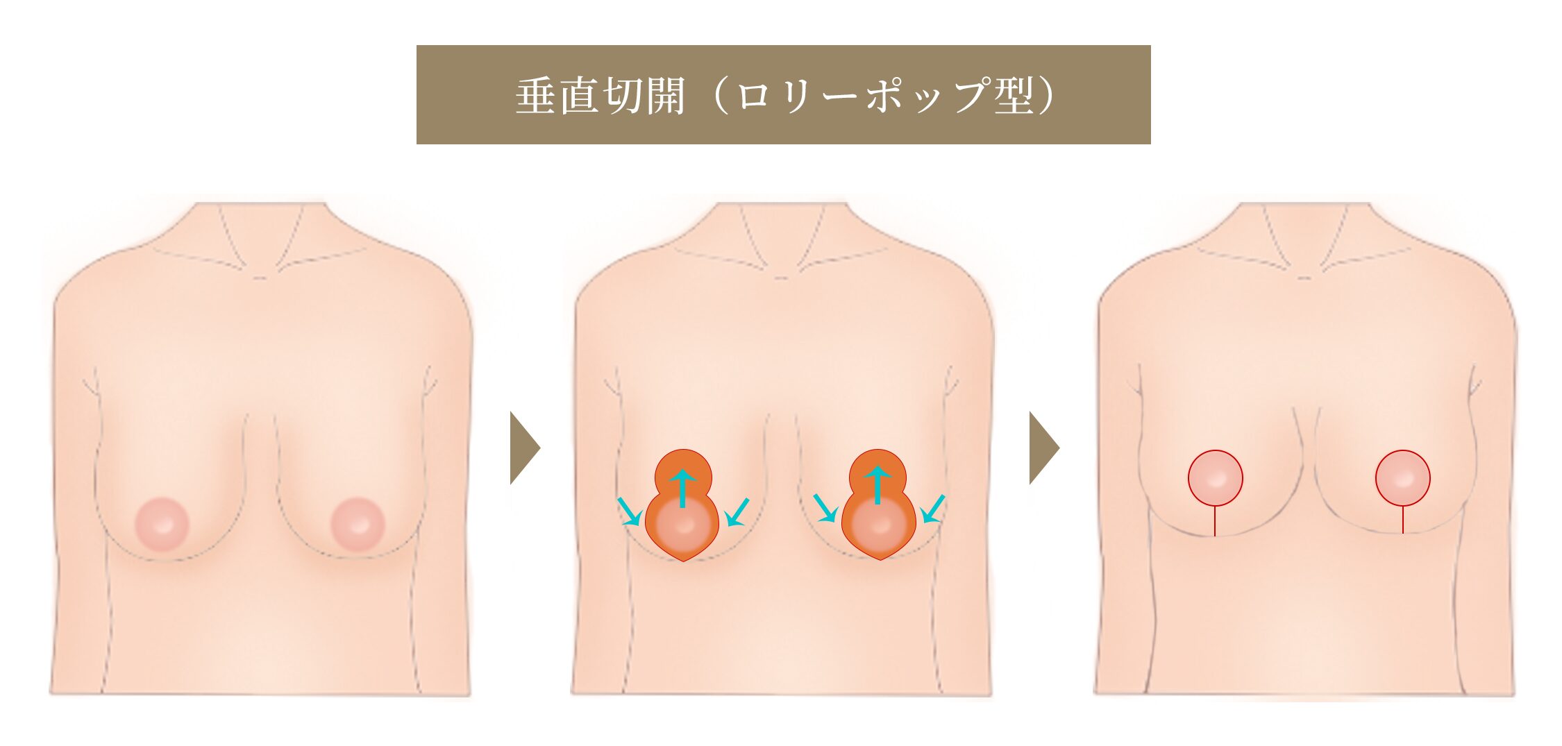 垂直切開