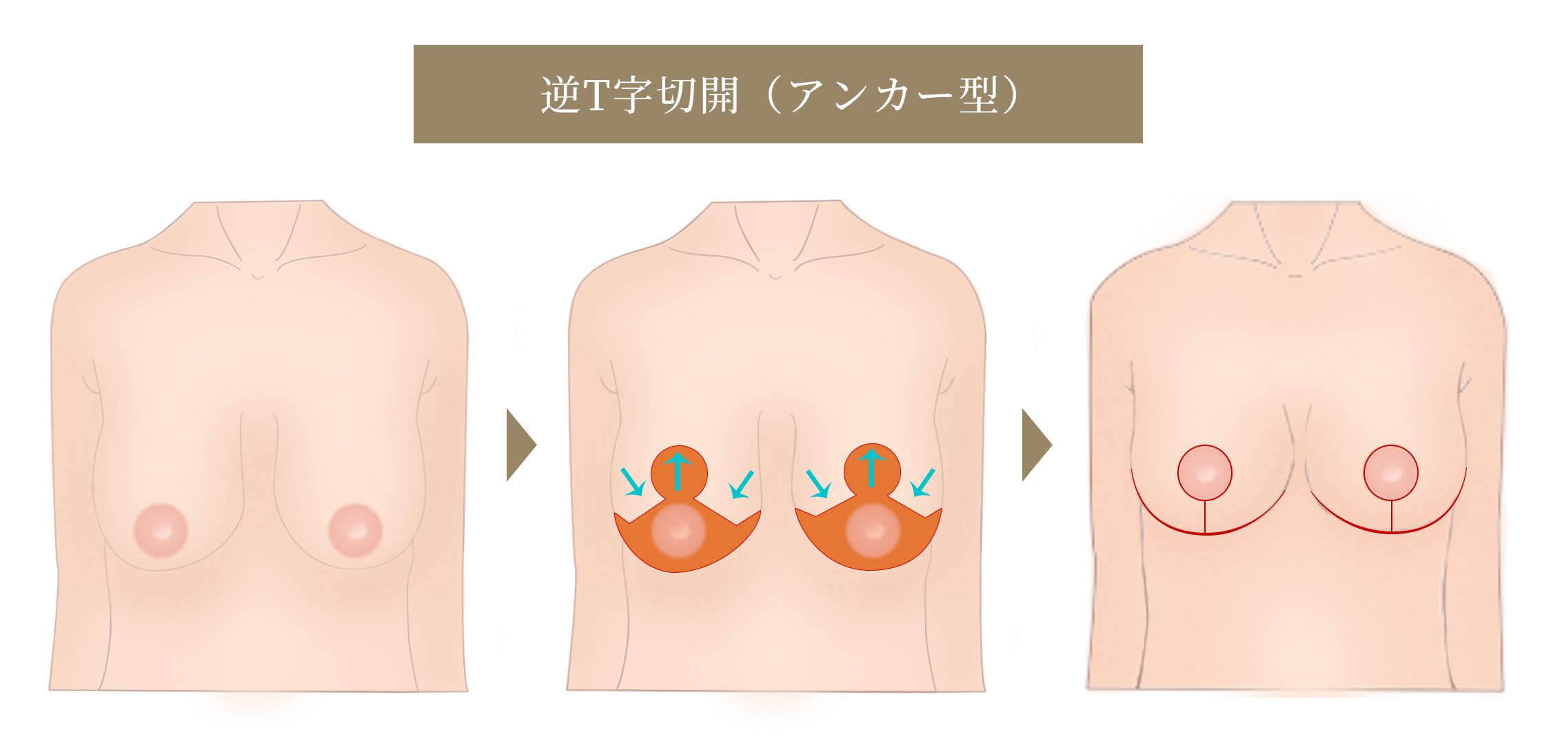逆T字切開