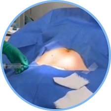 脂肪の採取＋採血