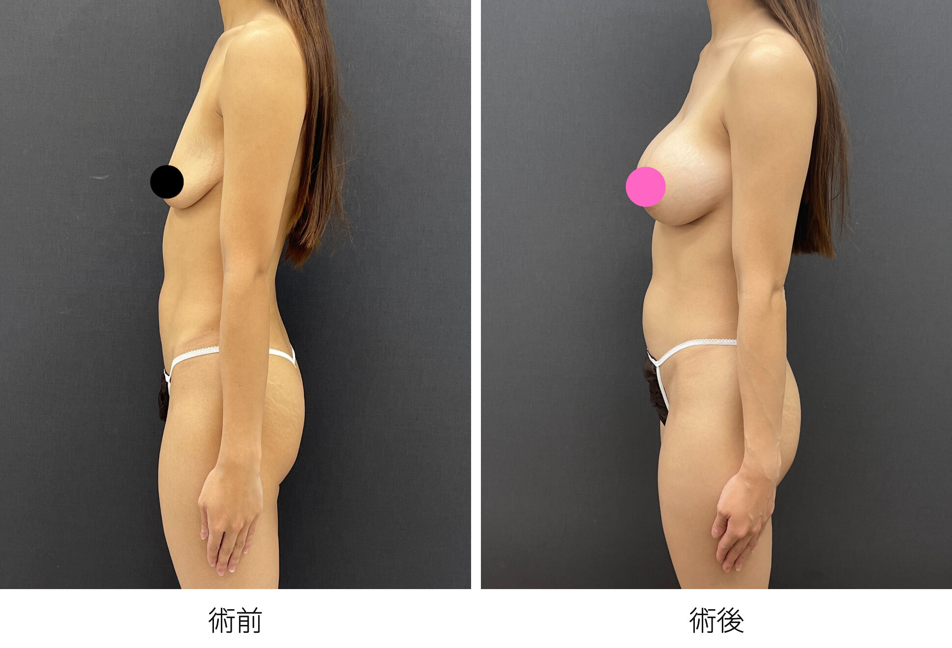 デュアルプレーン法 シリコンバッグ豊胸